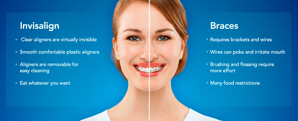 Sistema Invisalign