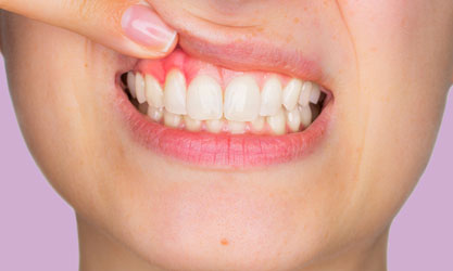 Plástica Periodontal