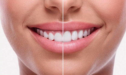 Plástica Periodontal